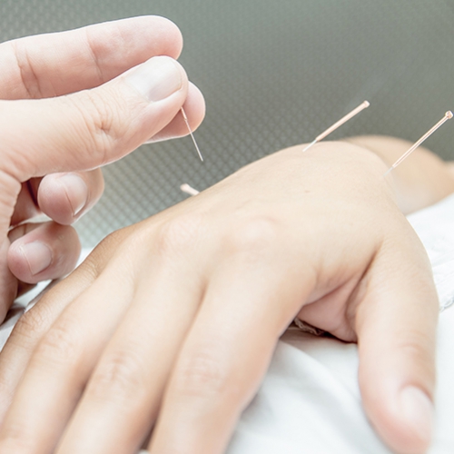 Acupuntura ajuda na reabilitação de pacientes