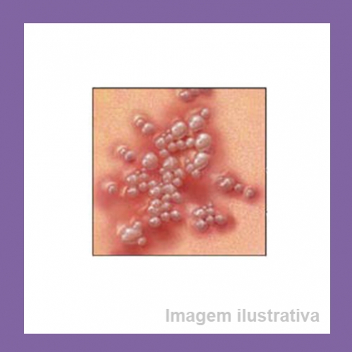 Como cuidar de herpes genital na gravidez