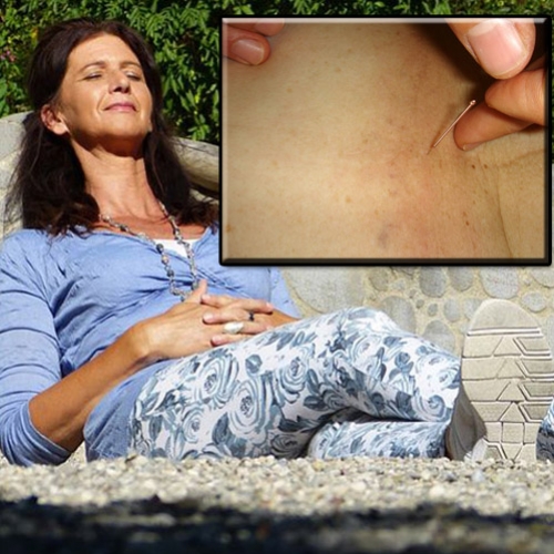 Acupuntura pode aliviar os sintomas da menopausa